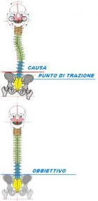 ernie scoliosi in osteopatia